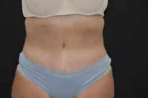 After Image: Tummy Tuck