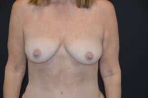 Before Image: Breast Lift with implants