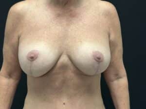 After Image: Breast Lift with implants